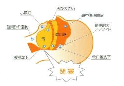 睡眠時無呼吸症候群とは？